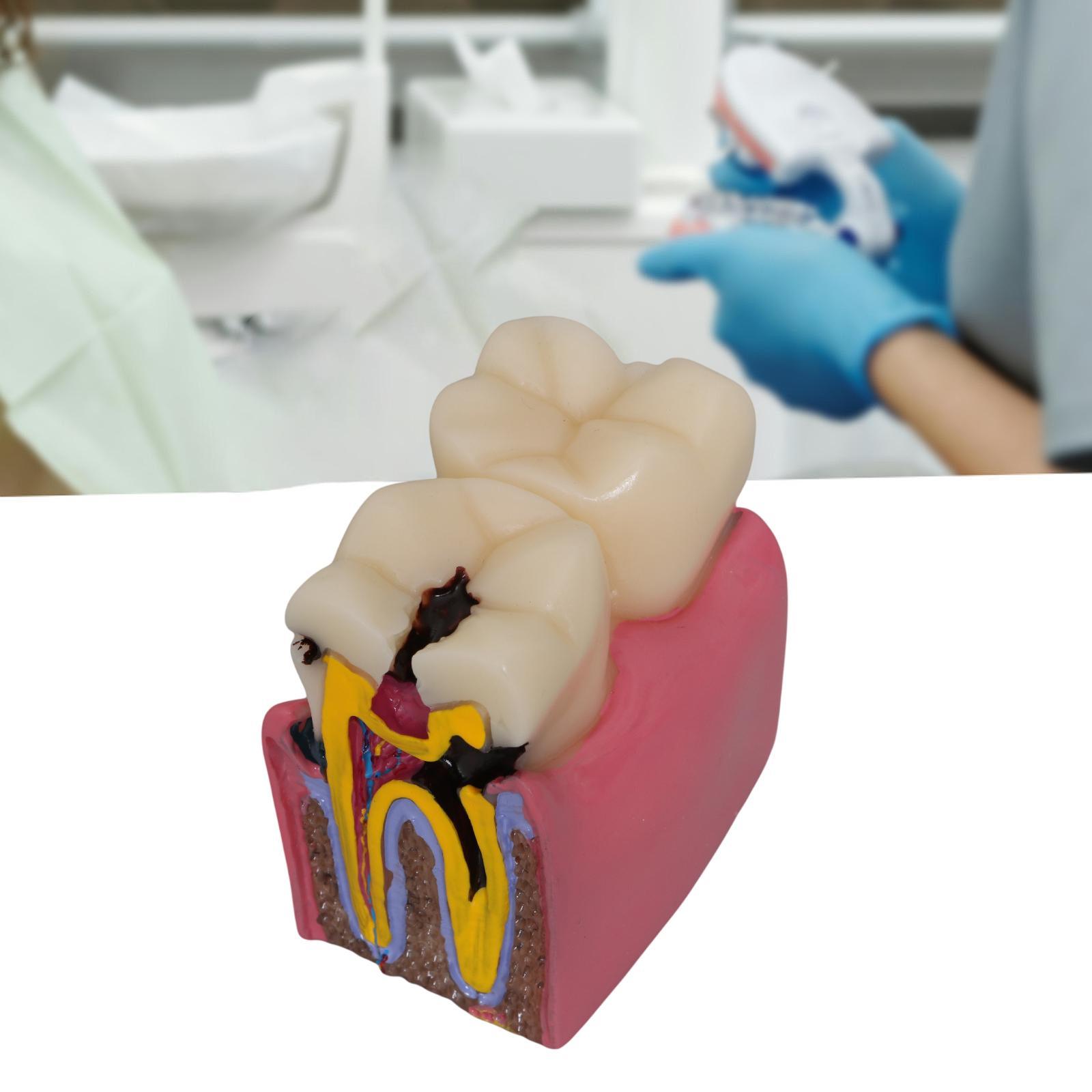 Kids Education Classes - Tooth Decay Model Roots Canal Teaching