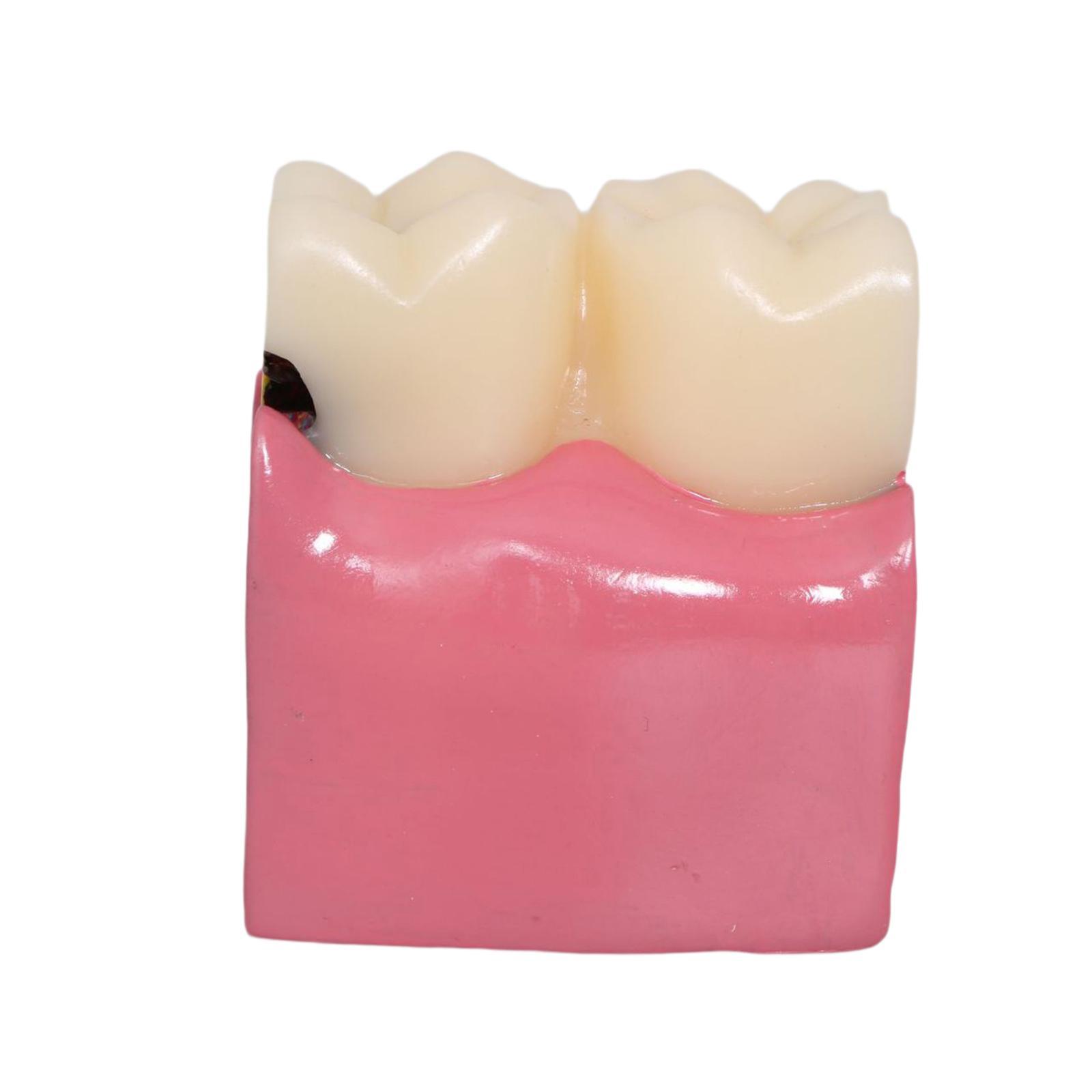 Tooth Decay Model Roots Canal  - Kids Education Classes ulasan dan harga