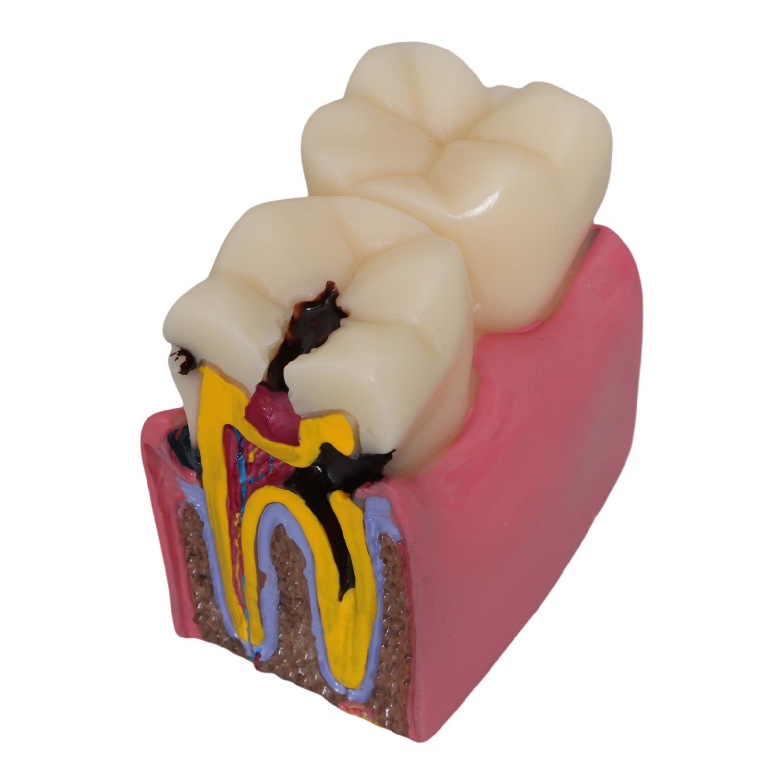 Tooth Decay Model Roots Canal  - Kids Education Classes ulasan dan harga